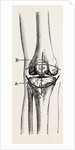Excision of the operation the limb by Anonymous