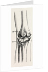 Excision of the operation the limb by Anonymous