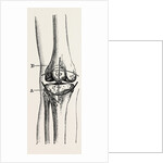 Excision of the operation the limb by Anonymous