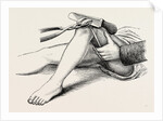 Excision of the knee, the sawing of the lower end by Anonymous