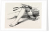 Excision of the knee, the sawing of the lower end by Anonymous