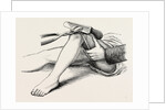 Excision of the knee, the sawing of the lower end by Anonymous