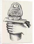 Excision of the knee by Anonymous