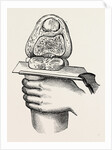 Excision of the knee by Anonymous