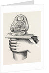 Excision of the knee by Anonymous