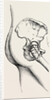 Excision of the hip by Anonymous