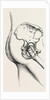 Excision of the hip by Anonymous