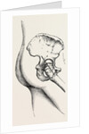 Excision of the hip by Anonymous