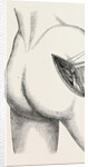 Excision of the hip by an external incision by Anonymous