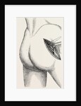 Excision of the hip by an external incision by Anonymous