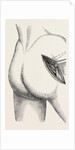 Excision of the hip by an external incision by Anonymous
