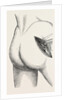 Excision of the hip by an external incision by Anonymous