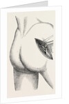 Excision of the hip by an external incision by Anonymous