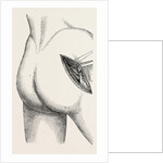 Excision of the hip by an external incision by Anonymous
