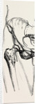 Excision by Anonymous
