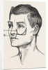Excision of the tipper jaw by Anonymous