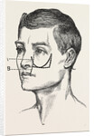 Excision of the tipper jaw by Anonymous