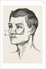 Excision of the tipper jaw by Anonymous