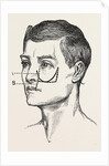 Excision of the tipper jaw by Anonymous