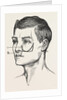Excision of the tipper jaw by Anonymous