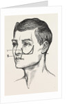 Excision of the tipper jaw by Anonymous