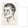 Excision of the tipper jaw by Anonymous