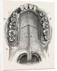 Nelaton's operation for nasal polypus by Anonymous