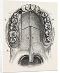 Nelaton's operation for nasal polypus by Anonymous