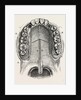 Nelaton's operation for nasal polypus by Anonymous