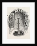 Nelaton's operation for nasal polypus by Anonymous