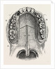 Nelaton's operation for nasal polypus by Anonymous