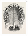 Nelaton's operation for nasal polypus by Anonymous