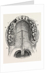 Nelaton's operation for nasal polypus by Anonymous