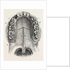 Nelaton's operation for nasal polypus by Anonymous