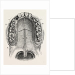 Nelaton's operation for nasal polypus by Anonymous
