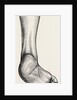 Incurved form of the foot, the planzar by Anonymous