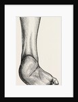 Incurved form of the foot, the planzar by Anonymous