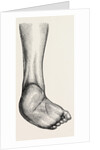 Incurved form of the foot, the planzar by Anonymous