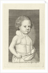Boy with a tumor by Pieter Willem van Megen