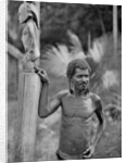 Malformation of the ears, Solomon Islands by JW Beattie
