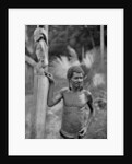 Malformation of the ears, Solomon Islands by JW Beattie