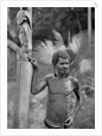 Malformation of the ears, Solomon Islands by JW Beattie