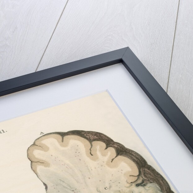 'Inflammation of the brain' by J Wedgewood