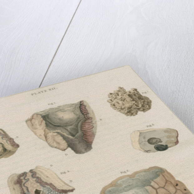 'Tubercles of the brain' by J Stewart senior