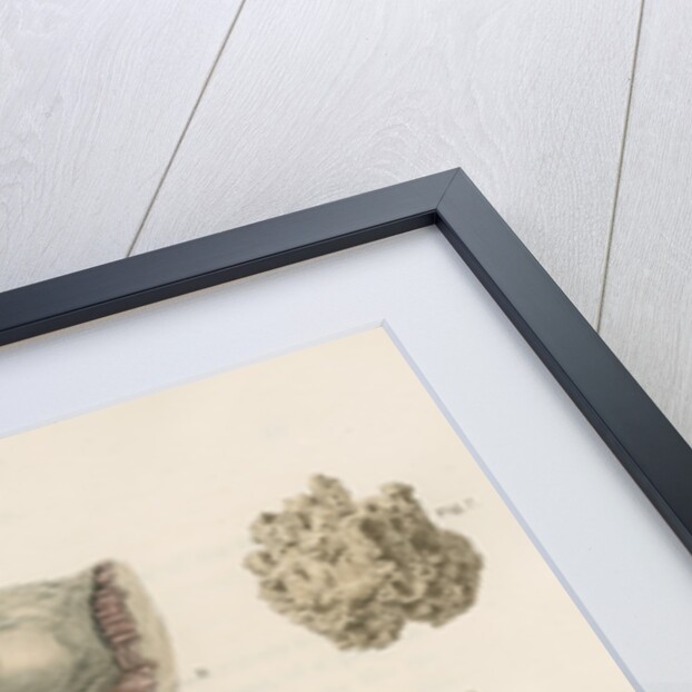 'Tubercles of the brain' by J Stewart senior