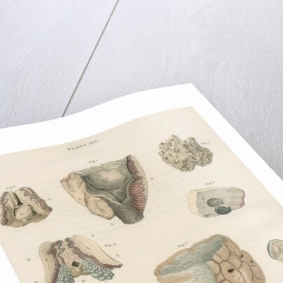 'Tubercles of the brain' by J Stewart senior