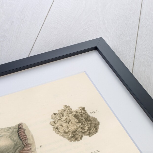 'Tubercles of the brain' by J Stewart senior