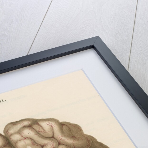 'Encysted tumour of the brain' by J Wedgewood