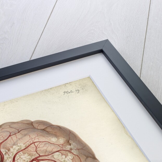 'Scrofulous tubercles in the brain' by C J Canton