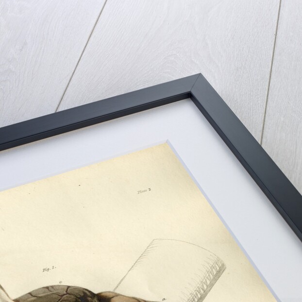 'Tumour of the pons Varolii' by William Say